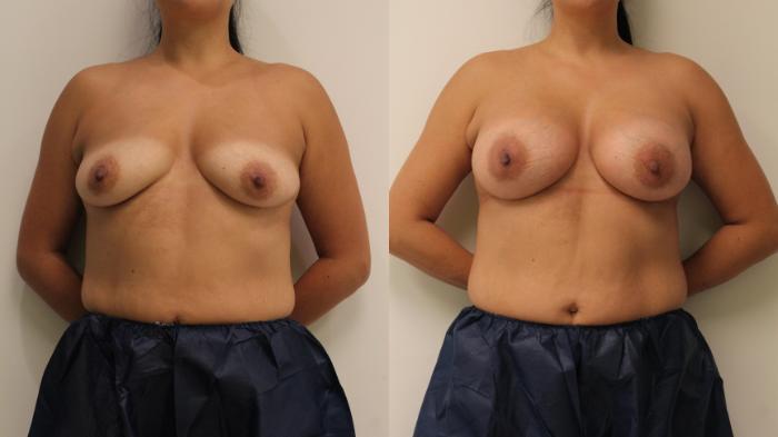 Before & After Breast Augmentation Case 131 Front View in Barrington, Illinois