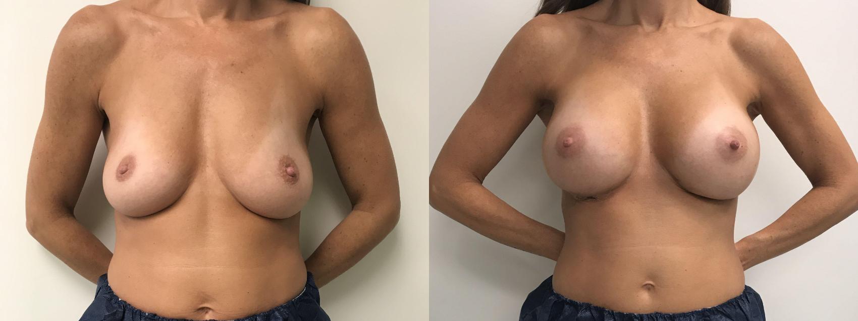 Before & After Breast Augmentation Case 136 Front View in Barrington, Illinois