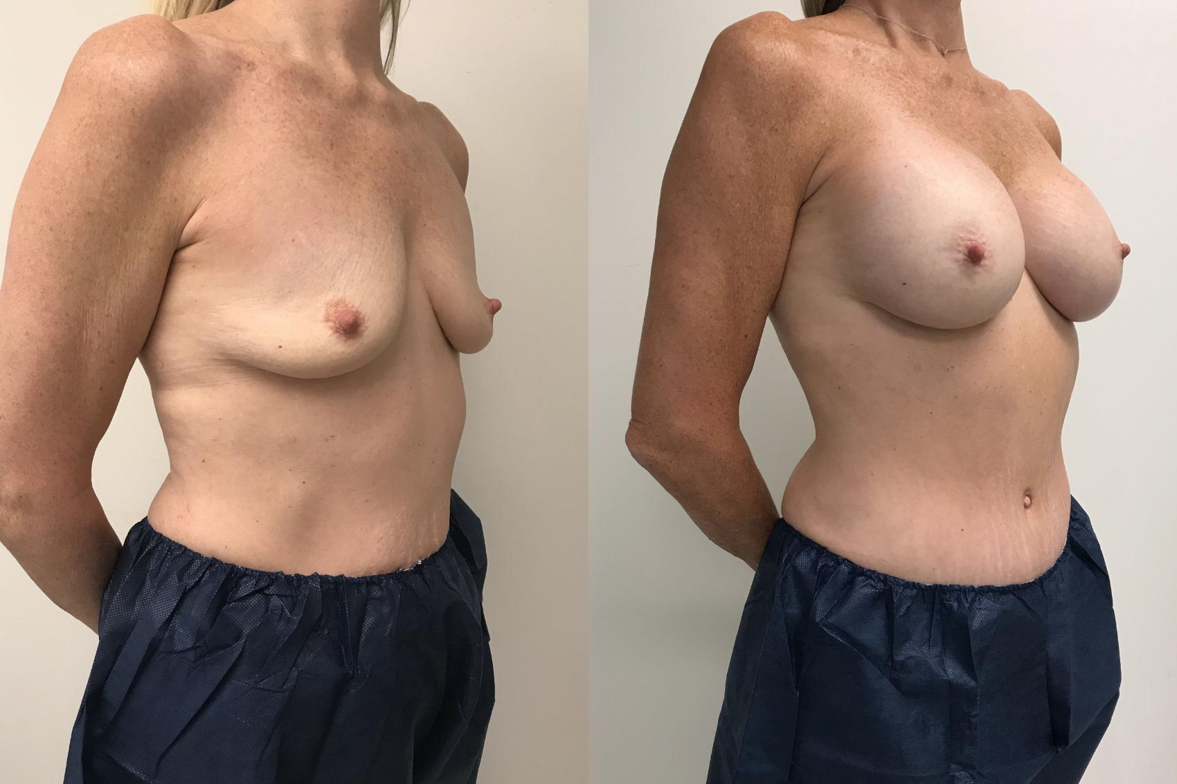 Before & After Breast Augmentation Case 151 Right Oblique View in Barrington, Illinois