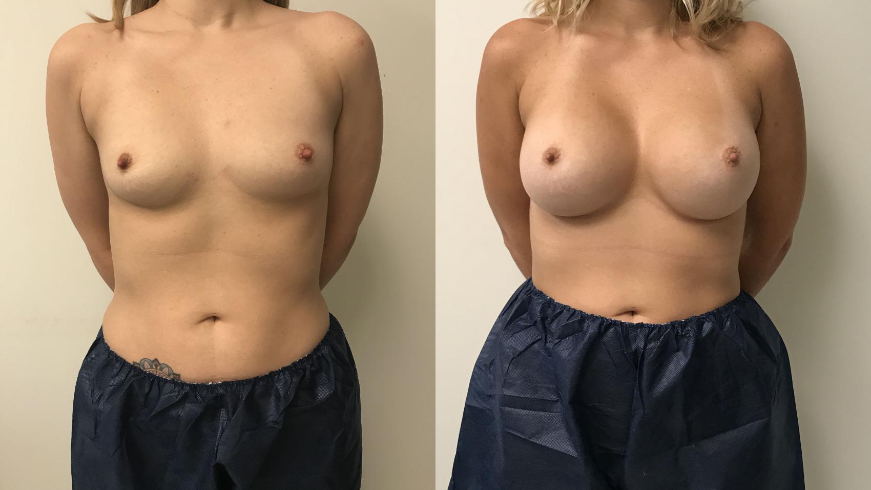 Before & After Breast Augmentation Case 157 Front View in Barrington, Illinois