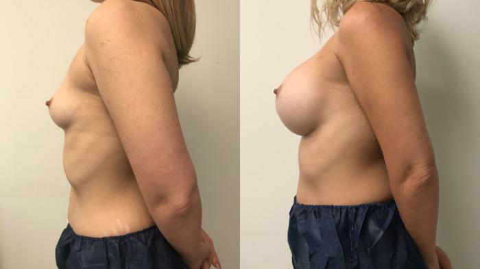 Before & After Breast Augmentation Case 157 Left Side View in Barrington, Illinois