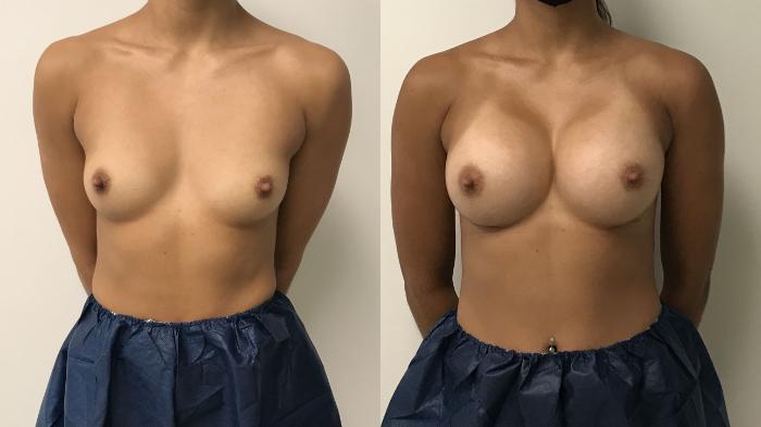 Before & After Breast Augmentation Case 220 Front View in Barrington, Illinois