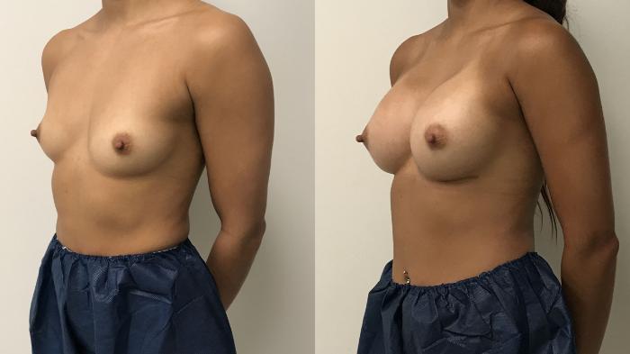Before & After Breast Augmentation Case 220 Left Oblique View in Barrington, Illinois