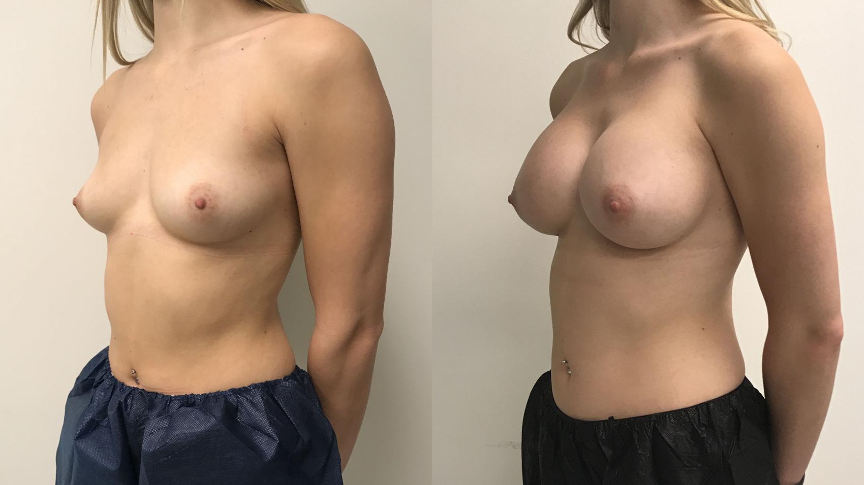 Before & After Breast Augmentation Case 227 Left Oblique View in Barrington, Illinois