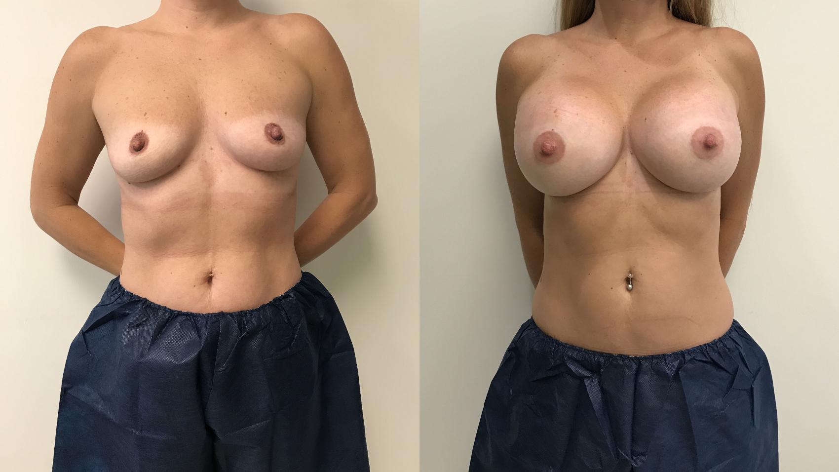 Before & After Breast Augmentation Case 236 Front View in Barrington, Illinois