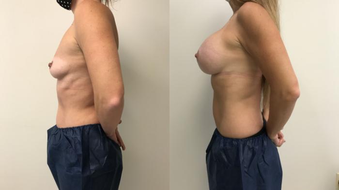 Before & After Breast Augmentation Case 236 Left Side View in Barrington, Illinois