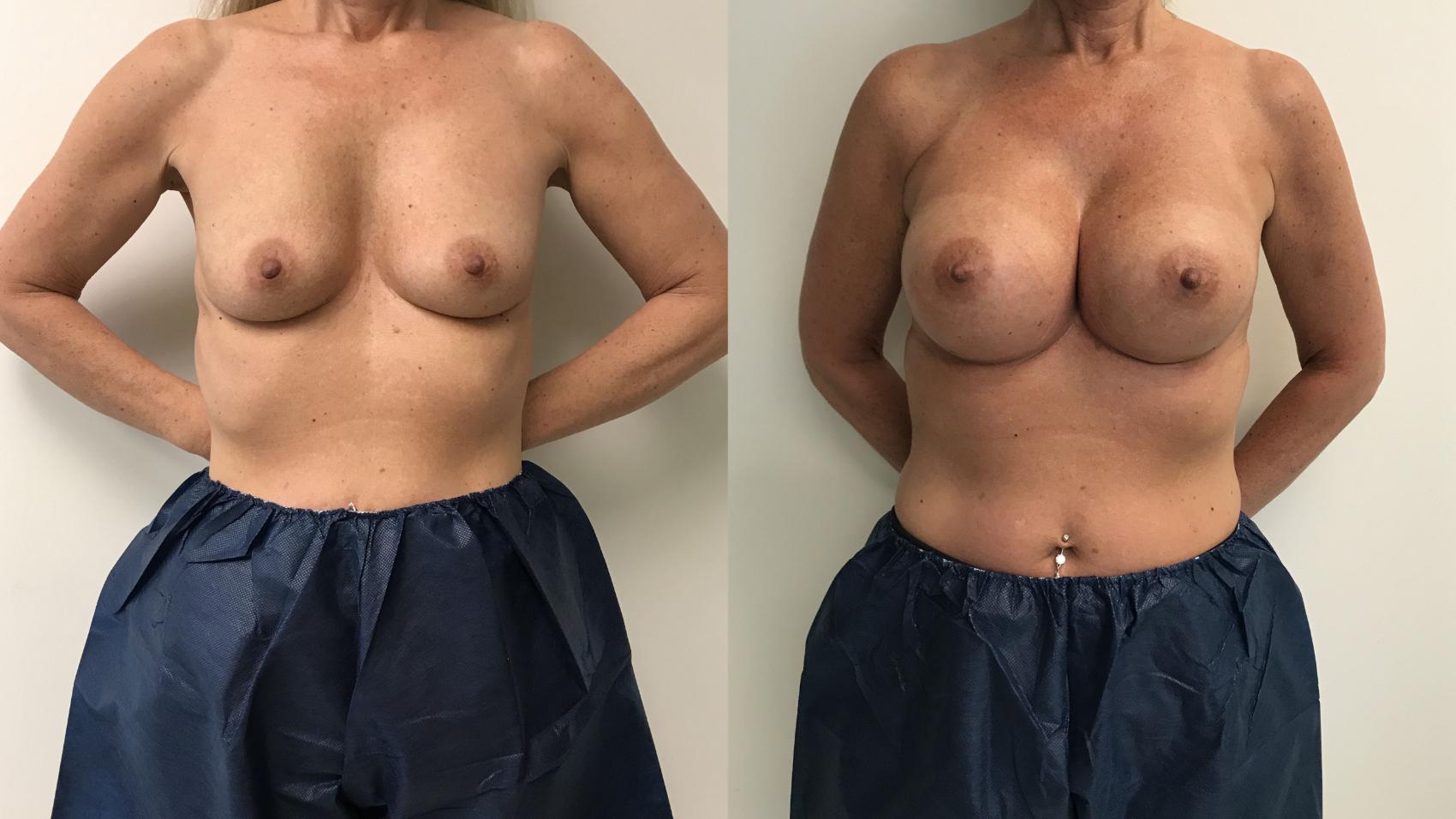 Before & After Breast Augmentation Case 237 Front View in Barrington, Illinois