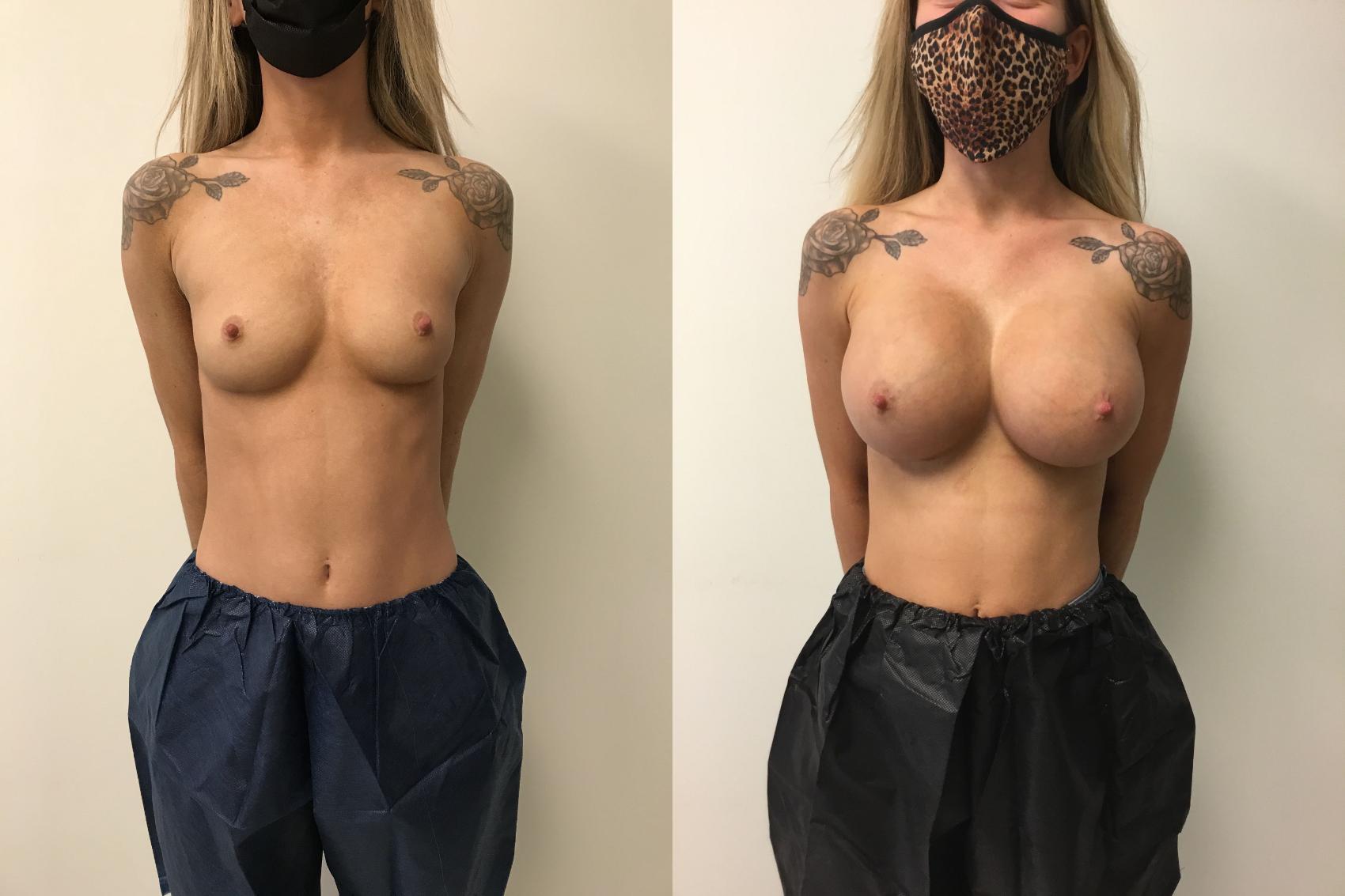 Before & After Breast Augmentation Case 239 Front View in Barrington, Illinois