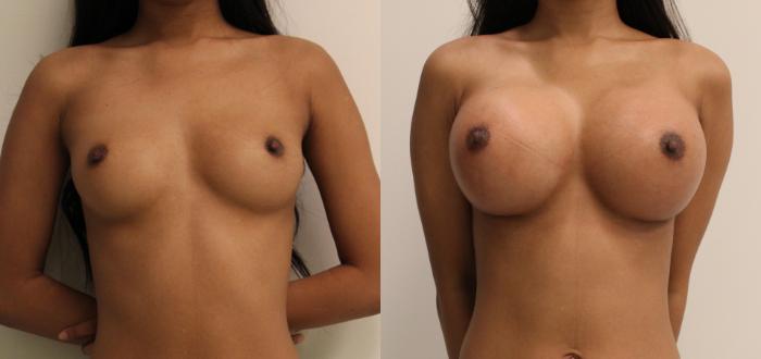 Before & After Breast Augmentation Case 24 View #1 View in Barrington, Illinois