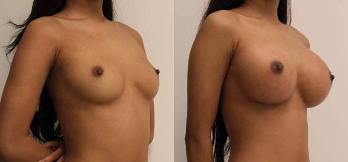 Before & After Breast Augmentation Case 24 View #2 View in Barrington, Illinois