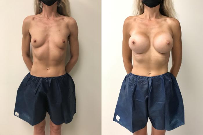 Before & After Breast Augmentation Case 250 Front View in Barrington, Illinois