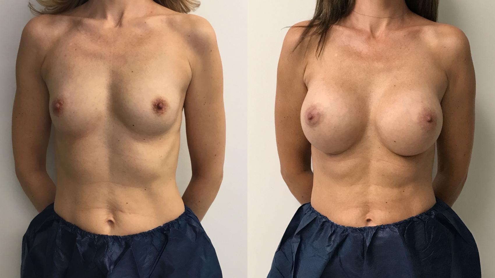 Before & After Breast Augmentation Case 267 Front View in Barrington, Illinois