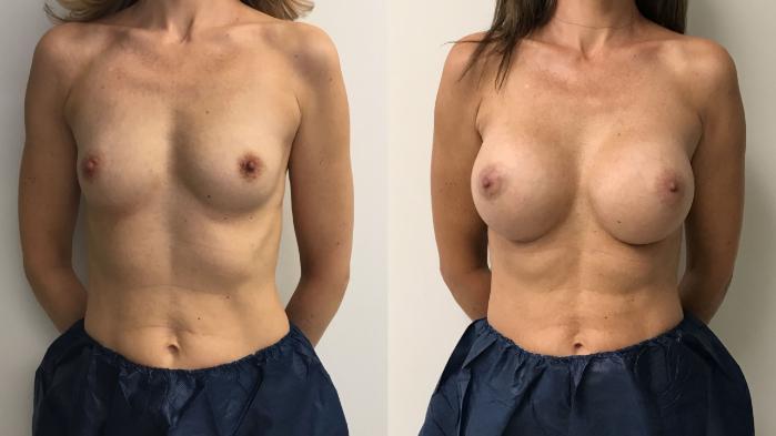 Before & After Breast Augmentation Case 267 Front View in Barrington, Illinois