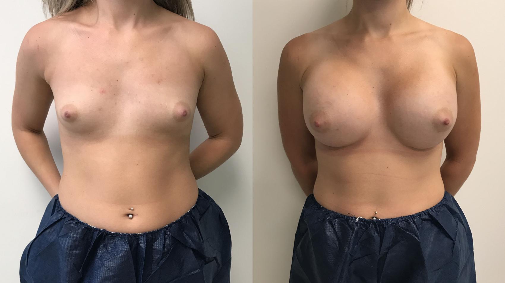 Before & After Breast Augmentation Case 270 Front View in Barrington, Illinois