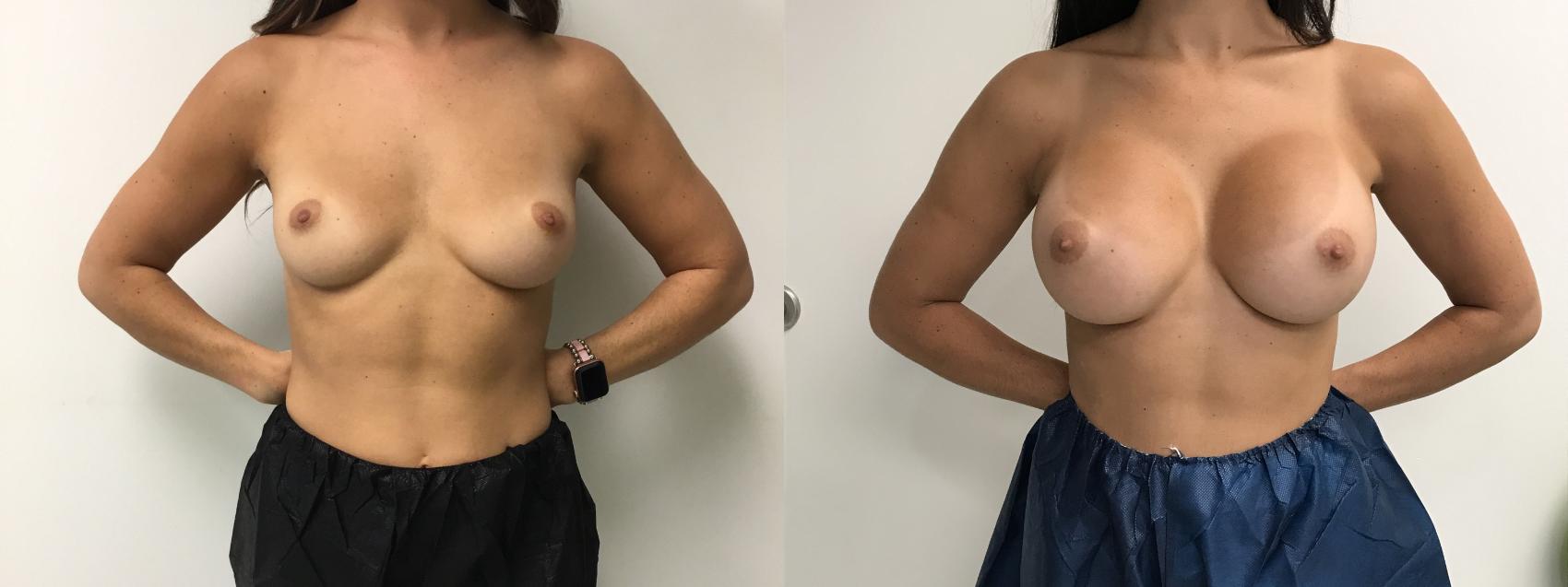 Before & After Breast Augmentation Case 275 Front View in Barrington, Illinois