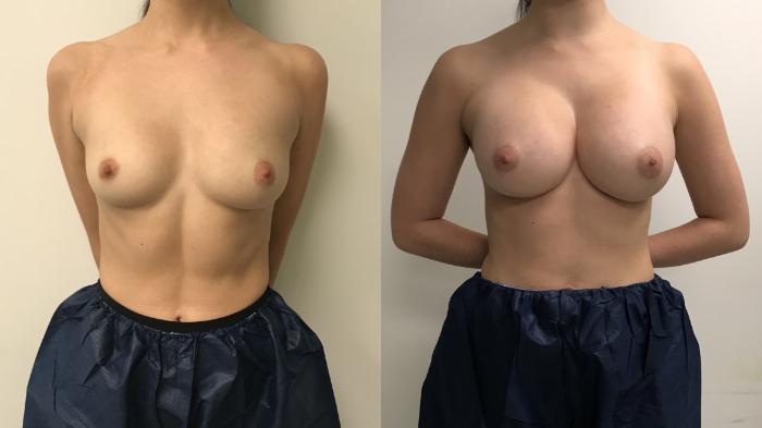 Before & After Breast Augmentation Case 286 Front View in Barrington, Illinois