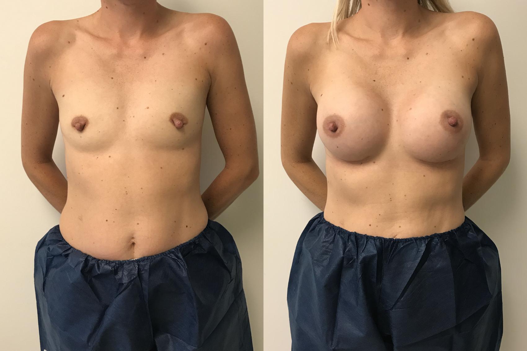 Before & After Breast Augmentation Case 290 Front View in Barrington, Illinois