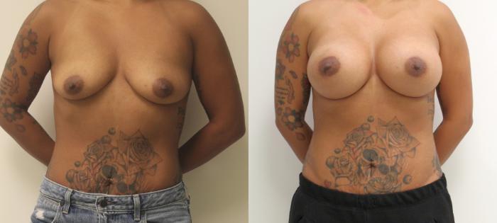 Before & After Breast Augmentation Case 32 View #1 View in Barrington, Illinois