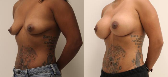 Before & After Breast Augmentation Case 32 View #2 View in Barrington, Illinois