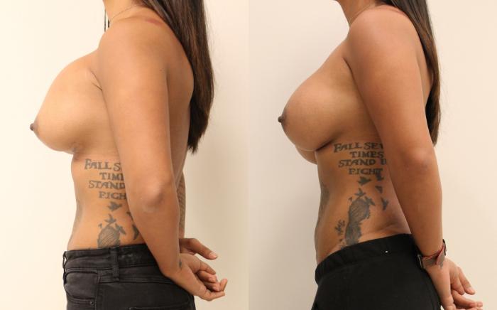 Before & After Breast Augmentation Case 32 View #3 View in Barrington, Illinois