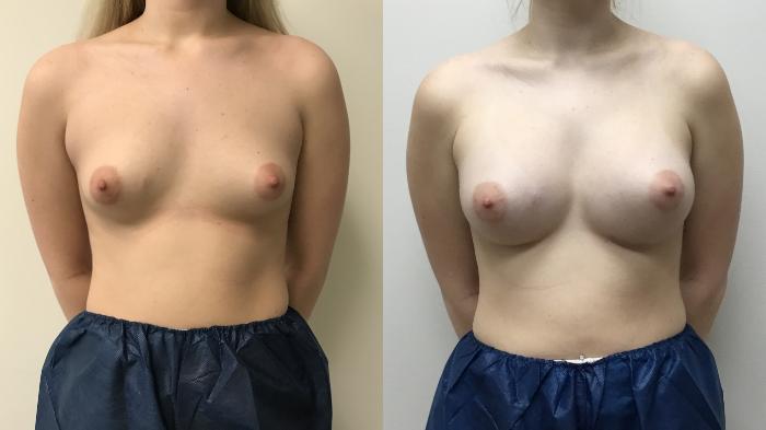 Before & After Breast Augmentation Case 335 Front View in Barrington, Illinois