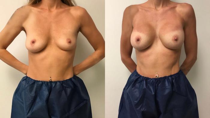 Before & After Breast Augmentation Case 338 Front View in Barrington, Illinois