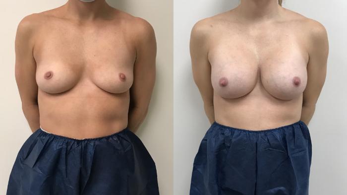 Before & After Breast Augmentation Case 339 Front View in Barrington, Illinois