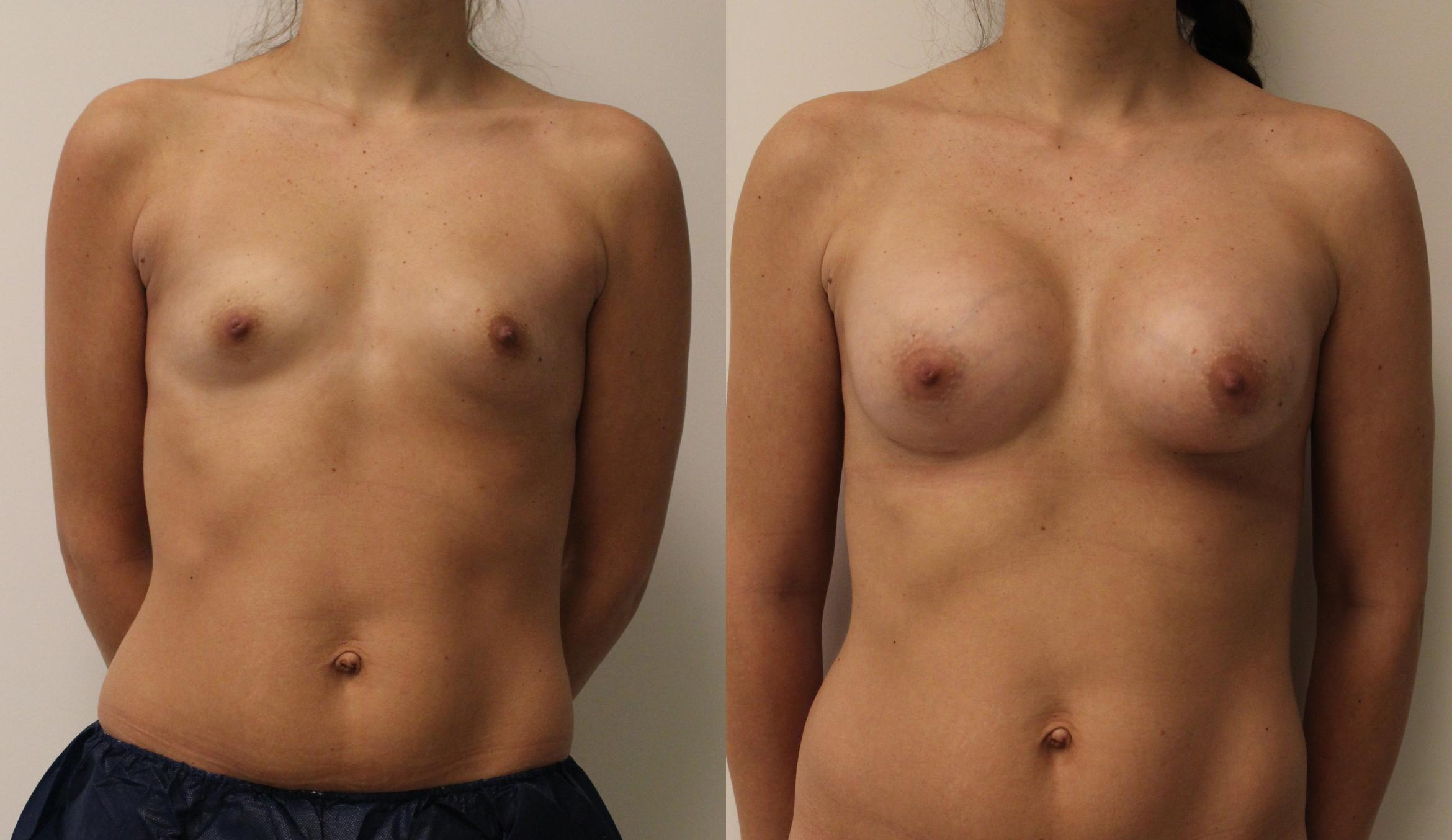 Breast implants with inverted nipples