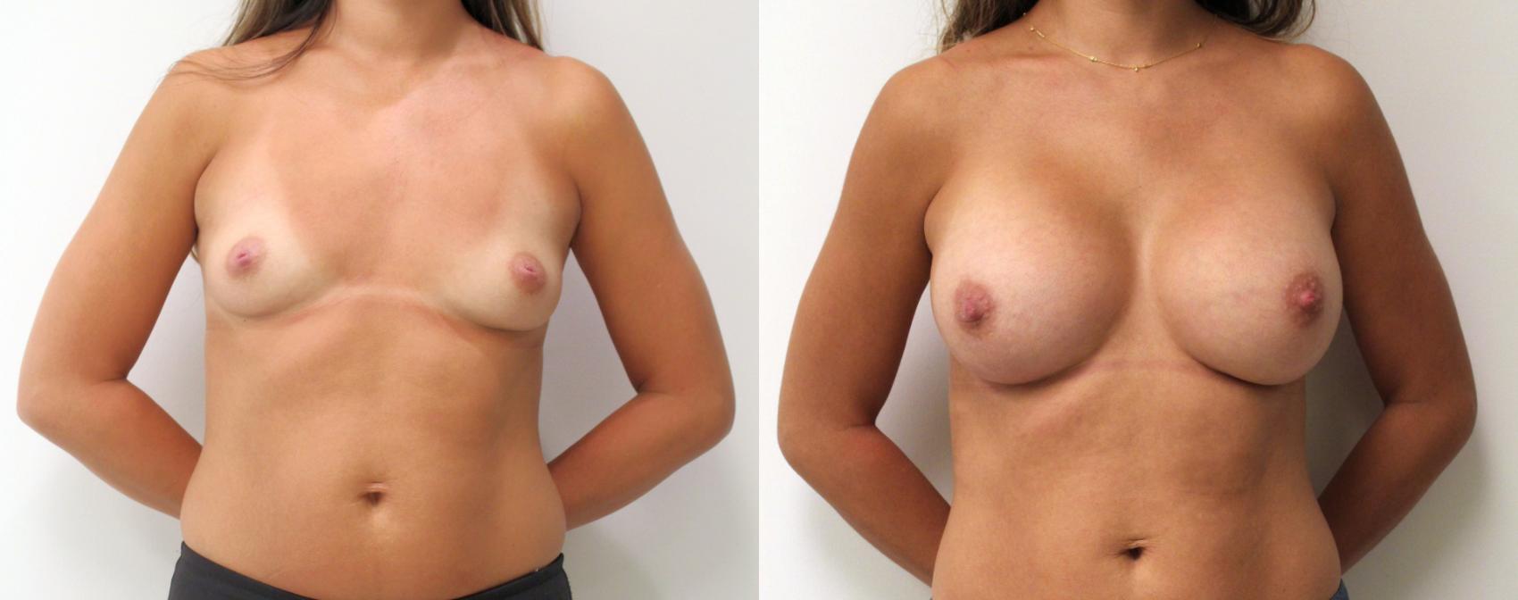 Before & After Breast Augmentation Case 35 View #1 View in Barrington, Illinois