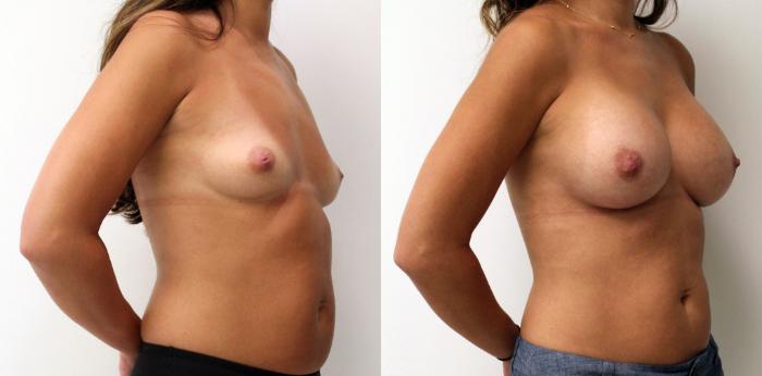 Before & After Breast Augmentation Case 35 View #2 View in Barrington, Illinois