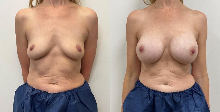 Before & After Breast Augmentation Case 357 Front View in Barrington, Illinois