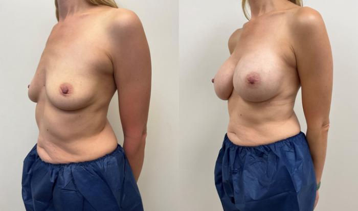 Before & After Breast Augmentation Case 357 Left Oblique View in Barrington, Illinois