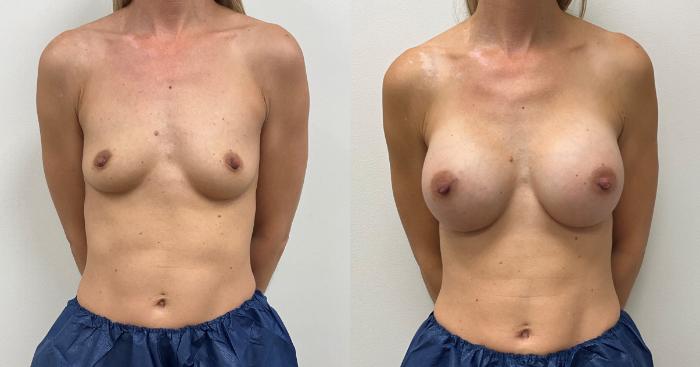 Before & After Breast Augmentation Case 358 Front View in Barrington, Illinois
