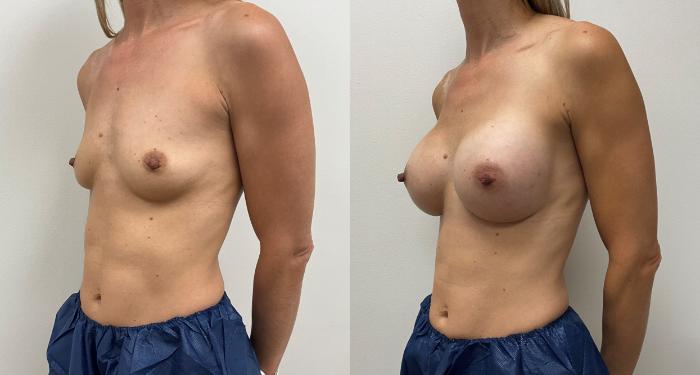 Before & After Breast Augmentation Case 358 Left Oblique View in Barrington, Illinois