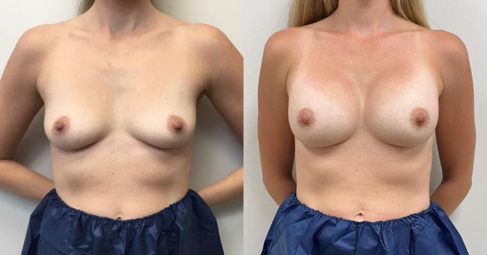 Before & After Breast Augmentation Case 361 Front View in Barrington, Illinois