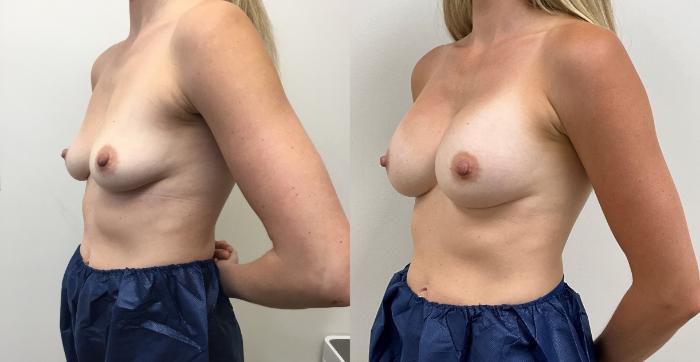 Before & After Breast Augmentation Case 361 Left Oblique View in Barrington, Illinois