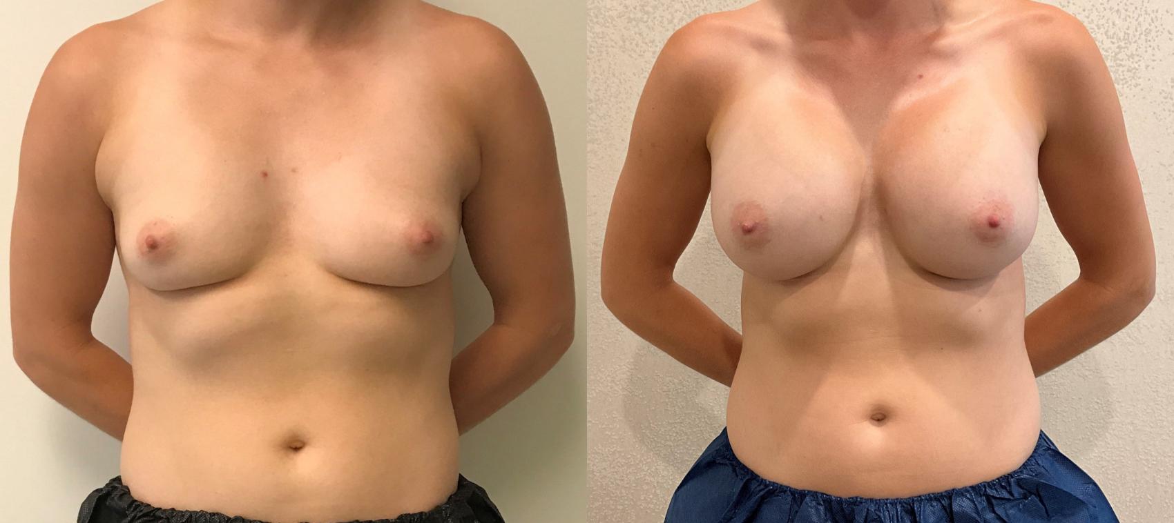 Before & After Breast Augmentation Case 366 Front View in Barrington, Illinois