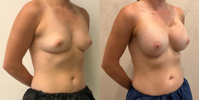 Before & After Breast Augmentation Case 366 Left Side View in Barrington, Illinois