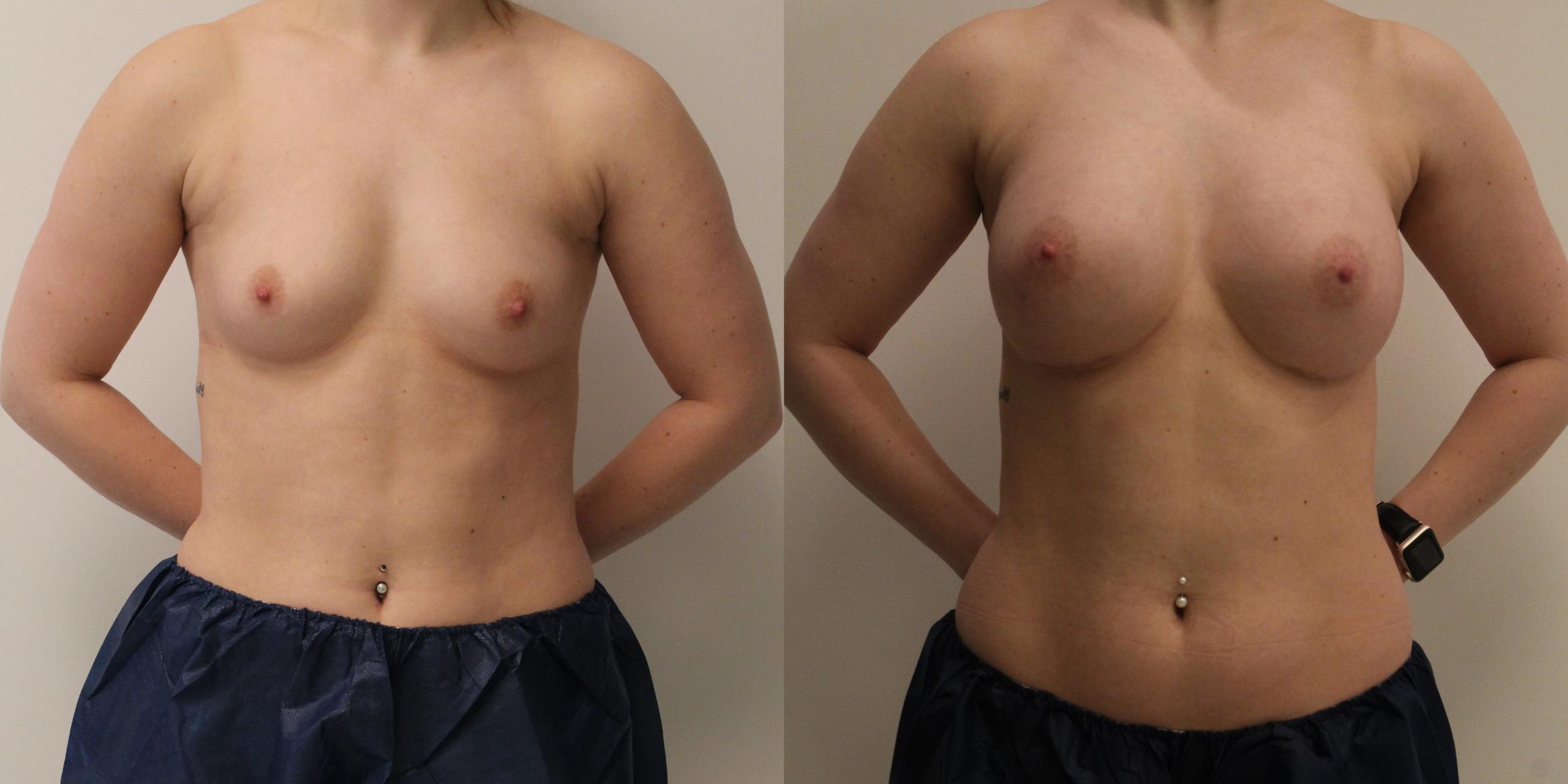 Before & After Breast Augmentation Case 37 View #1 View in Barrington, Illinois