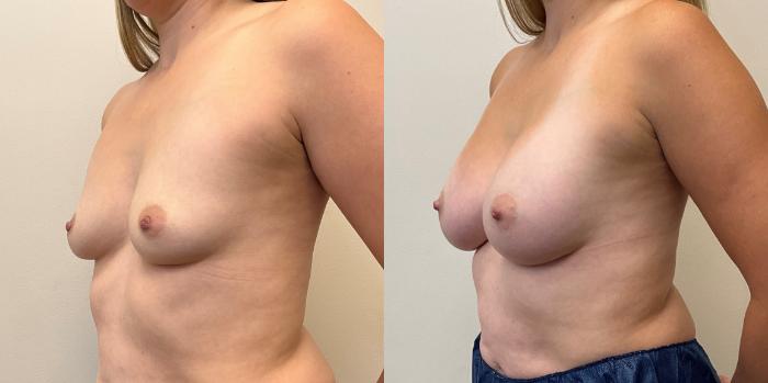 Before & After Breast Augmentation Case 372 Left Oblique View in Barrington, Illinois