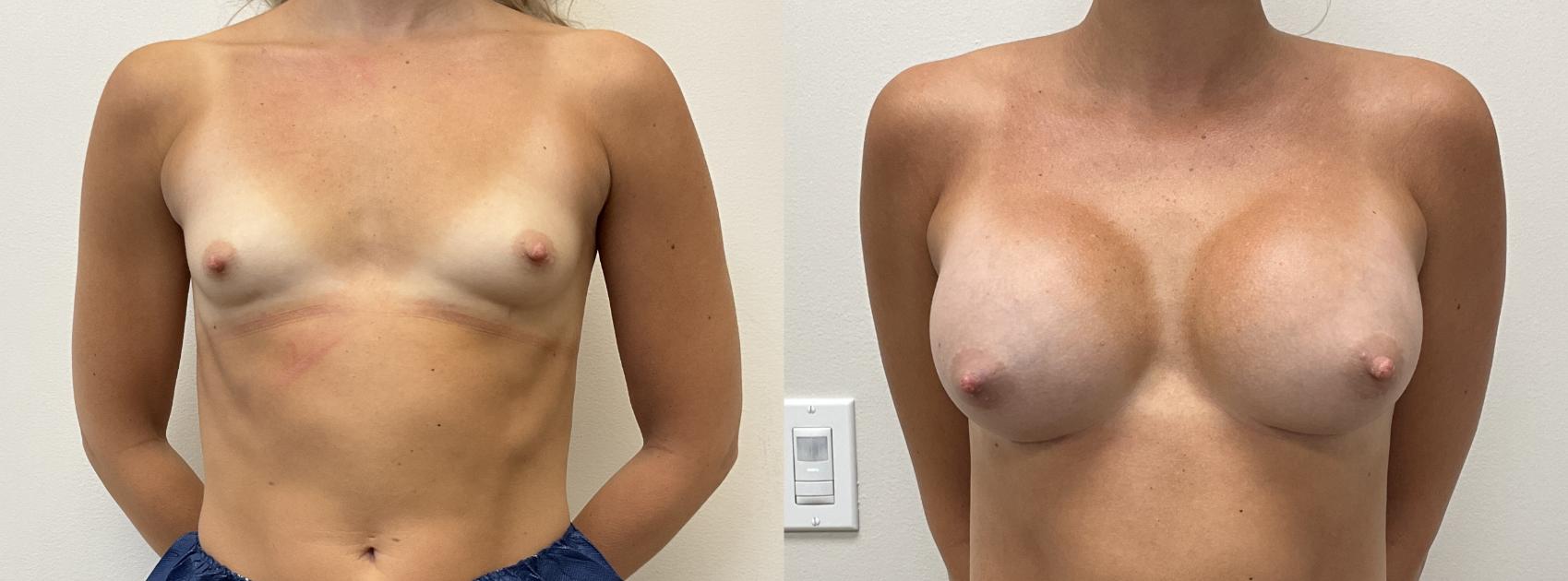 Before & After Breast Augmentation Case 377 Front View in Barrington, Illinois