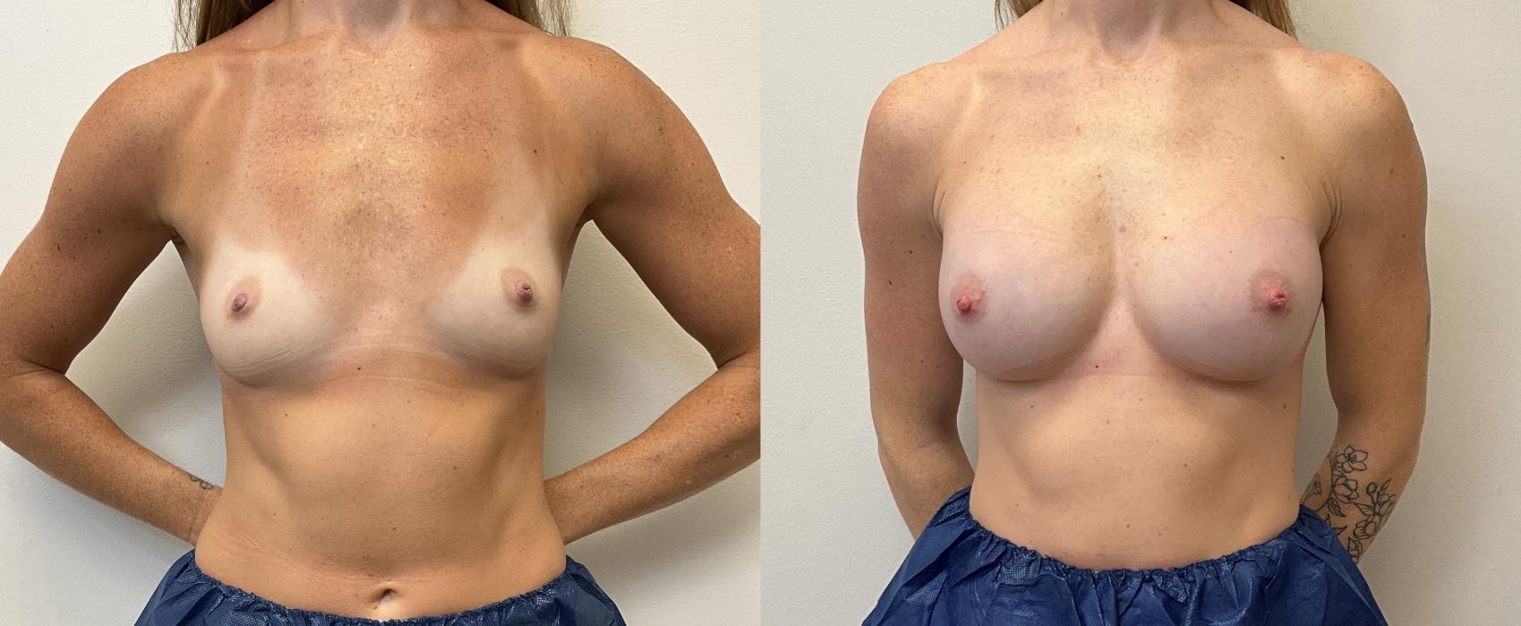 Before & After Breast Augmentation Case 380 Front View in Barrington, Illinois