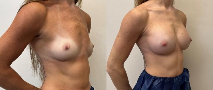 Before & After Breast Augmentation Case 380 Right Oblique View in Barrington, Illinois