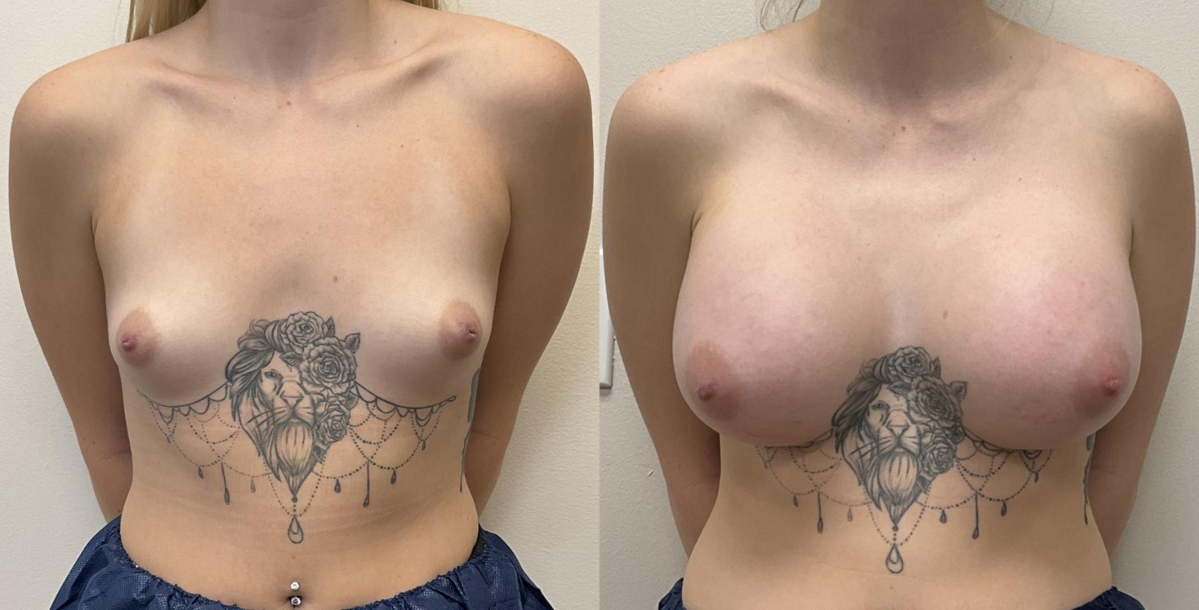 Before & After Breast Augmentation Case 381 Front View in Barrington, Illinois