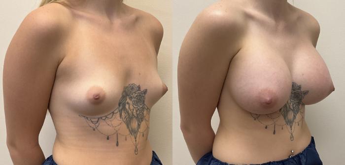 Before & After Breast Augmentation Case 381 Right Oblique View in Barrington, Illinois