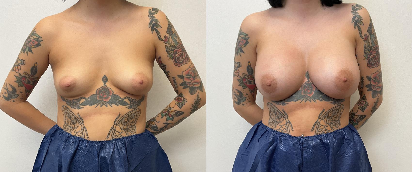Before & After Breast Augmentation Case 382 Front View in Barrington, Illinois