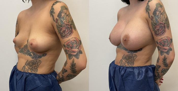 Before & After Breast Augmentation Case 382 Left Oblique View in Barrington, Illinois