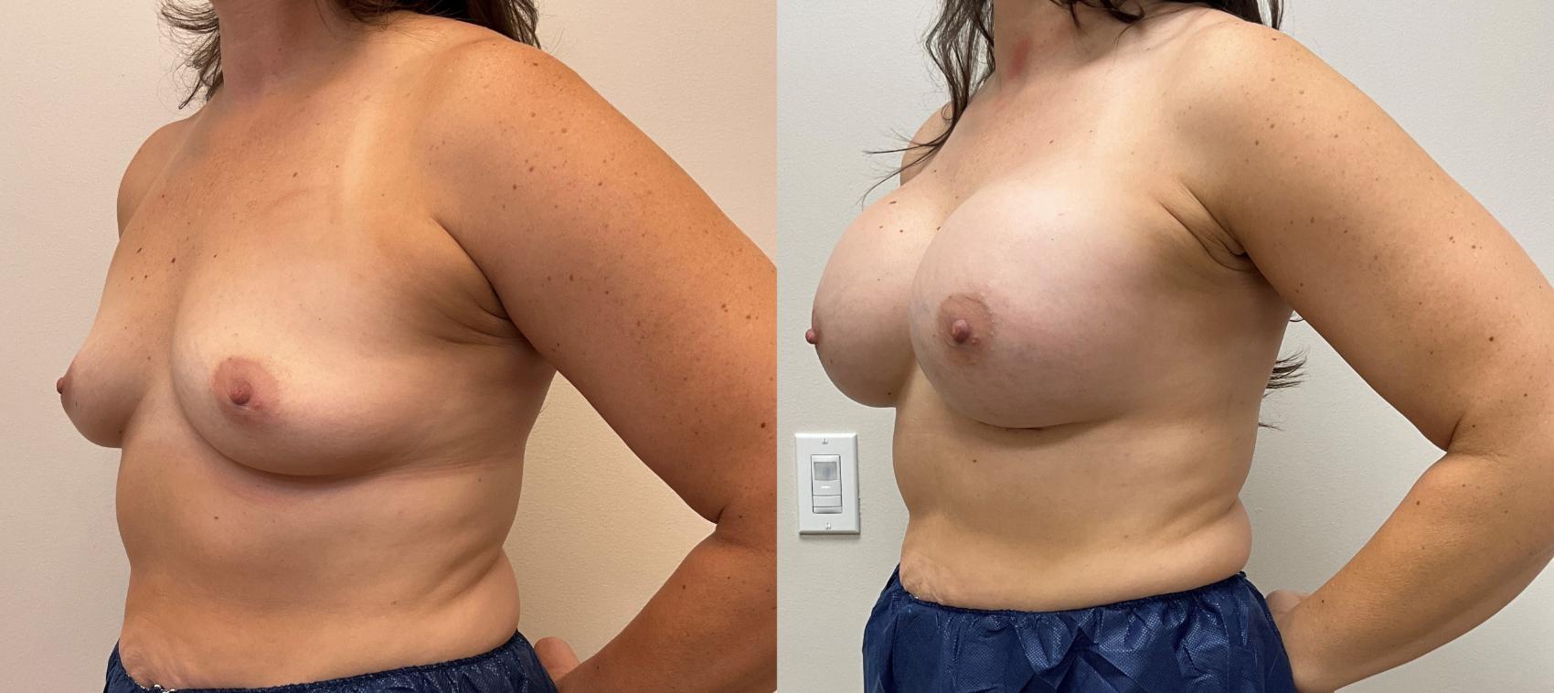 Before & After Breast Augmentation Case 389 Front View in Barrington, Illinois