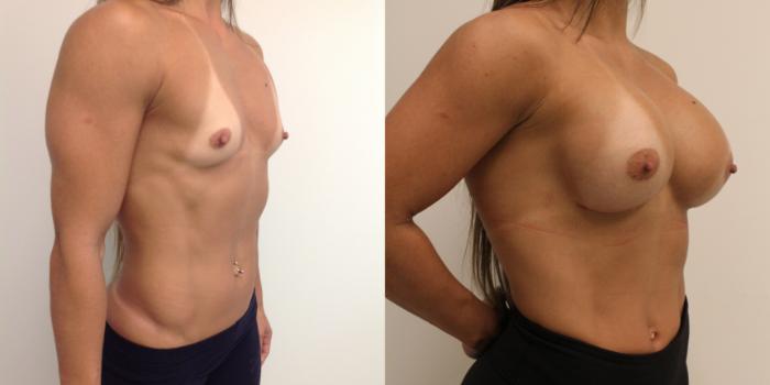 Before & After Breast Augmentation Case 39 View #2 View in Barrington, Illinois