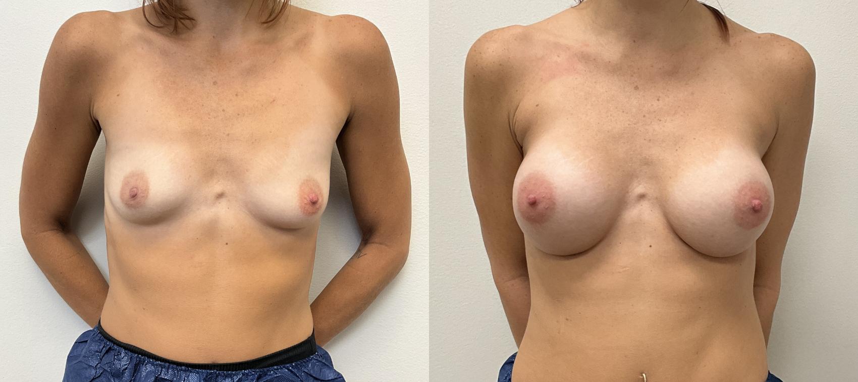 Before & After Breast Augmentation Case 415 Front View in Barrington, Illinois